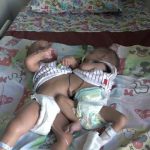 Bayi Kembar Siam 1